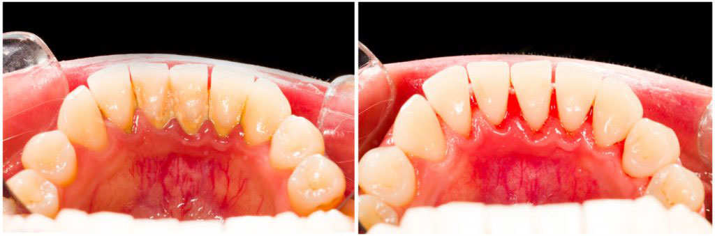 The image shows a close-up view of a set of teeth with visible signs of decay and wear, likely for dental education purposes.