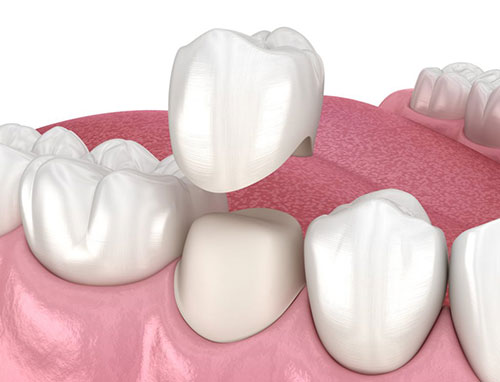 The image displays a 3D rendering of an open mouth with multiple teeth showing, including front incisors and back molars, set against a pink background that resembles gums, with the focus on dental hygiene or oral health.