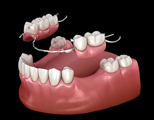 The image shows a 3D rendering of an upper denture with multiple artificial teeth and a partial lower denture, both set against a black background, designed for accessibility purposes.