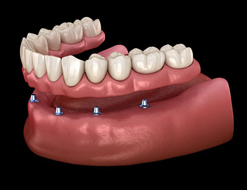 The image shows a 3D rendering of a human mouth with teeth and gums, highlighting dental implants or prosthetics, set against a black background.