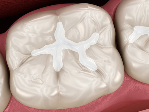 The image shows a close-up view of a human tooth with dental work being performed, specifically a filling procedure where material is being placed into a cavity.