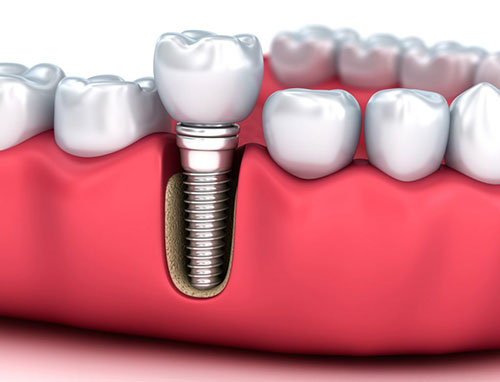 An up-close image of a dental implant screwed into a tooth socket within a red dental tray.