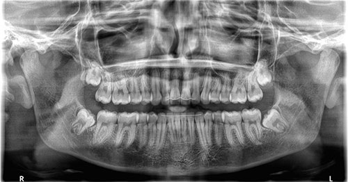 The image displays a full-mouth dental X-ray with the teeth and jaw clearly visible against a dark background.