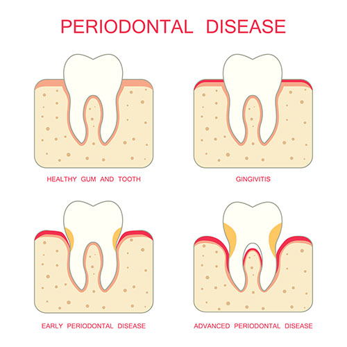 The image displays a series of illustrations showing different stages of dental decay, from initial tooth wear to advanced gum disease, with accompanying text labels explaining each stage.