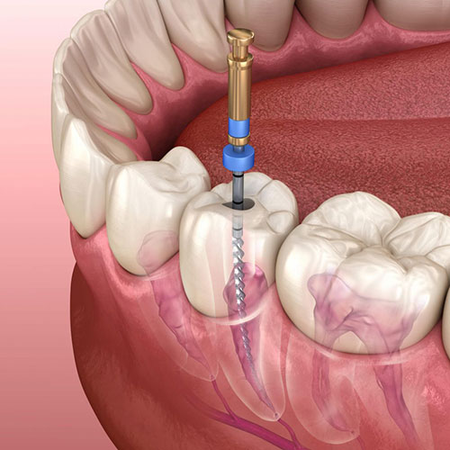 The image shows an oral cavity with a tooth being drilled, featuring a blue surgical instrument inserted into the center of the tooth, against a pink background that resembles human teeth and gums.